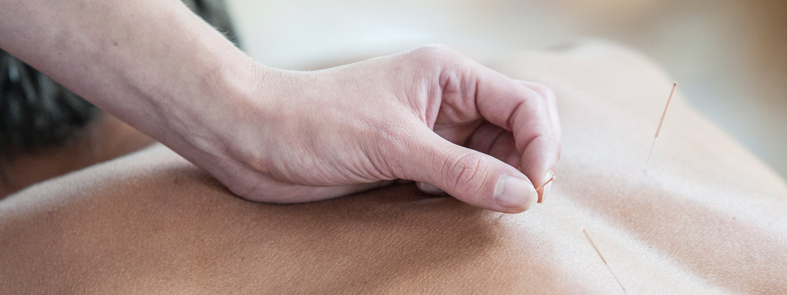 Akupunktur